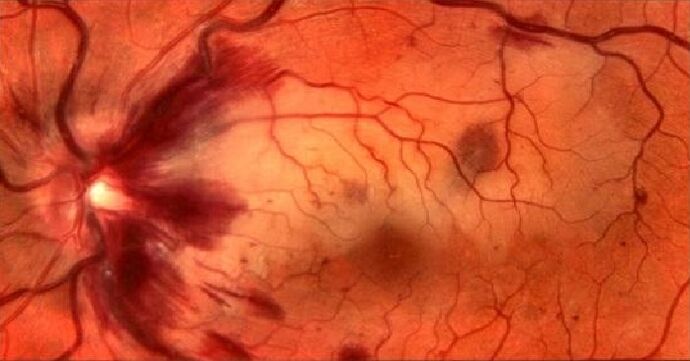 retinal blood vessels and restoration of vision